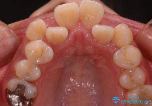 八重歯・下の前歯が2本足りない(20代女性)・ILFsystem・審美装置の治療前