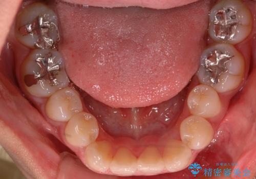 八重歯・下の前歯が2本足りない(20代女性)・ILFsystem・審美装置の治療前