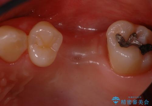 サイナスソケットリフト併用の上顎奥歯のインプラントの治療前