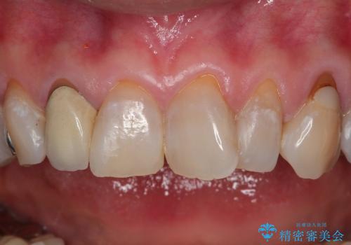 前歯6本のオールセラミック(50代女性)の治療前