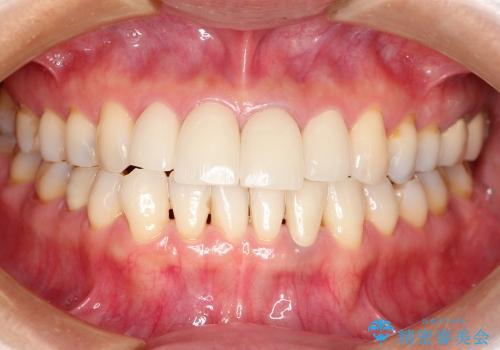 前歯のセラミッククラウンのやり換え(30代女性)の治療後