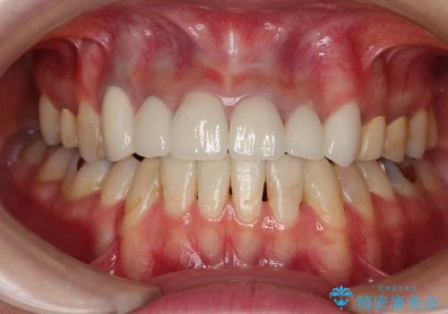前歯6本のオールセラミック治療例(20代女性)の治療後