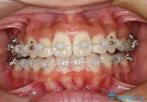 八重歯・下の前歯が2本足りない(20代女性)・ILFsystem・審美装置の治療中