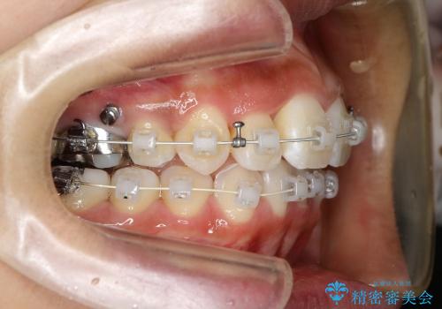 八重歯・下の前歯が2本足りない(20代女性)・ILFsystem・審美装置の治療中