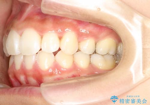八重歯・下の前歯が2本足りない(20代女性)・ILFsystem・審美装置の治療後