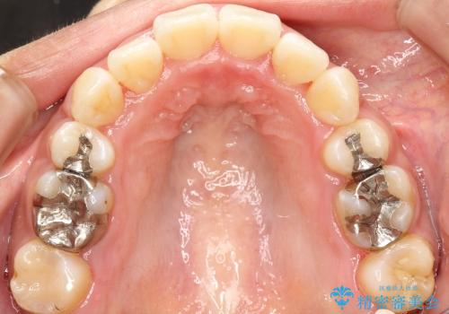 八重歯・下の前歯が2本足りない(20代女性)・ILFsystem・審美装置の治療後