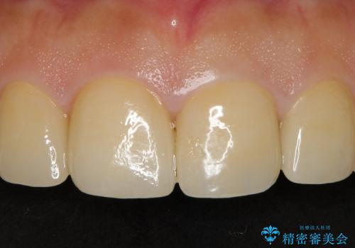 前歯や奥歯のむし歯治療(20代女性)の治療後