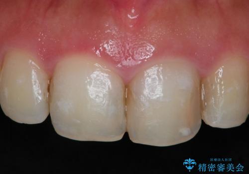 前歯や奥歯のむし歯治療(20代女性)の治療前