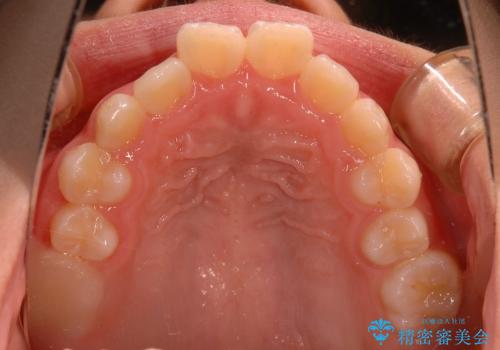 出っ歯(上顎前突)・ペンデュラム装置・メタル・小児矯正・非抜歯の治療前