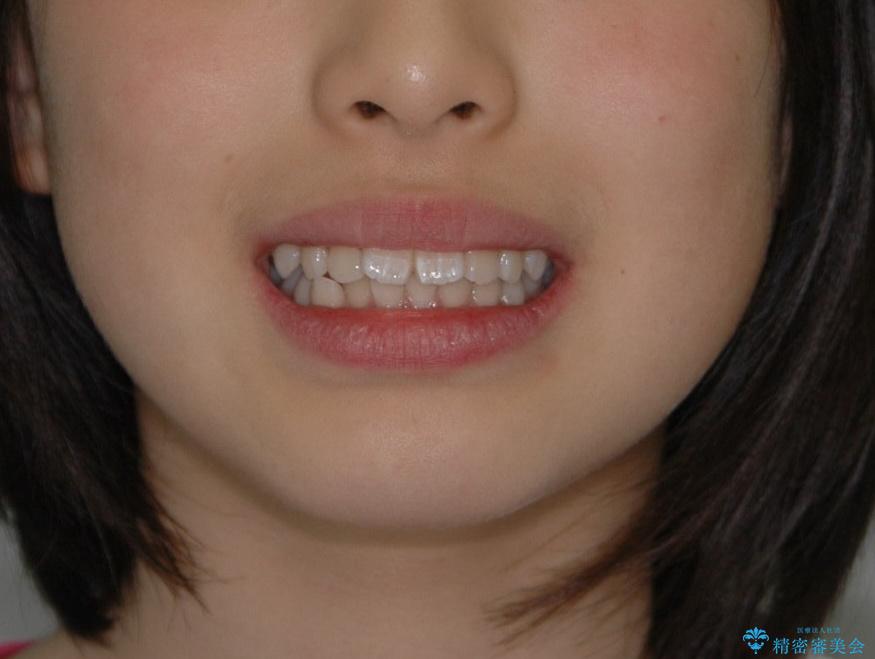 出っ歯(上顎前突)・ペンデュラム装置・メタル・小児矯正・非抜歯の治療前（顔貌）