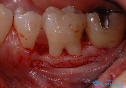 根分岐部病変と三壁性骨欠損部の歯周組織再生治療の治療後