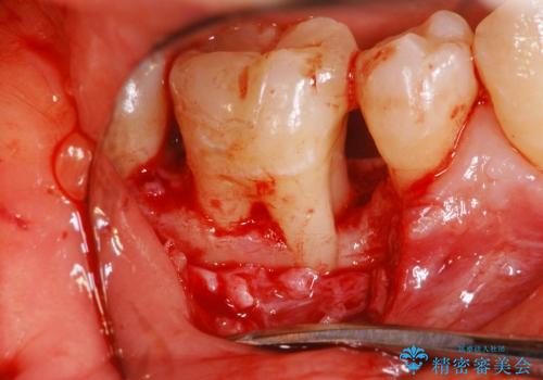 歯周組織再生治療の治療後