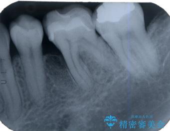 根分岐部病変と三壁性骨欠損部の歯周組織再生治療の治療後