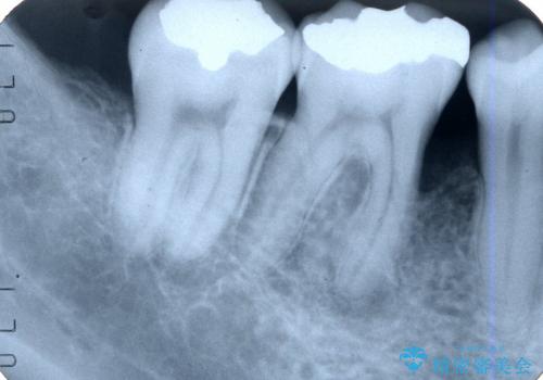 歯周組織再生治療の治療後