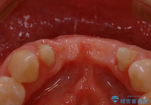 下顎前歯部の歯槽堤増大術　根面被覆　オールセラミック治療の治療後
