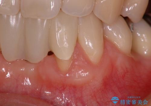下顎前歯部の歯槽堤増大術　根面被覆　オールセラミック治療の治療前