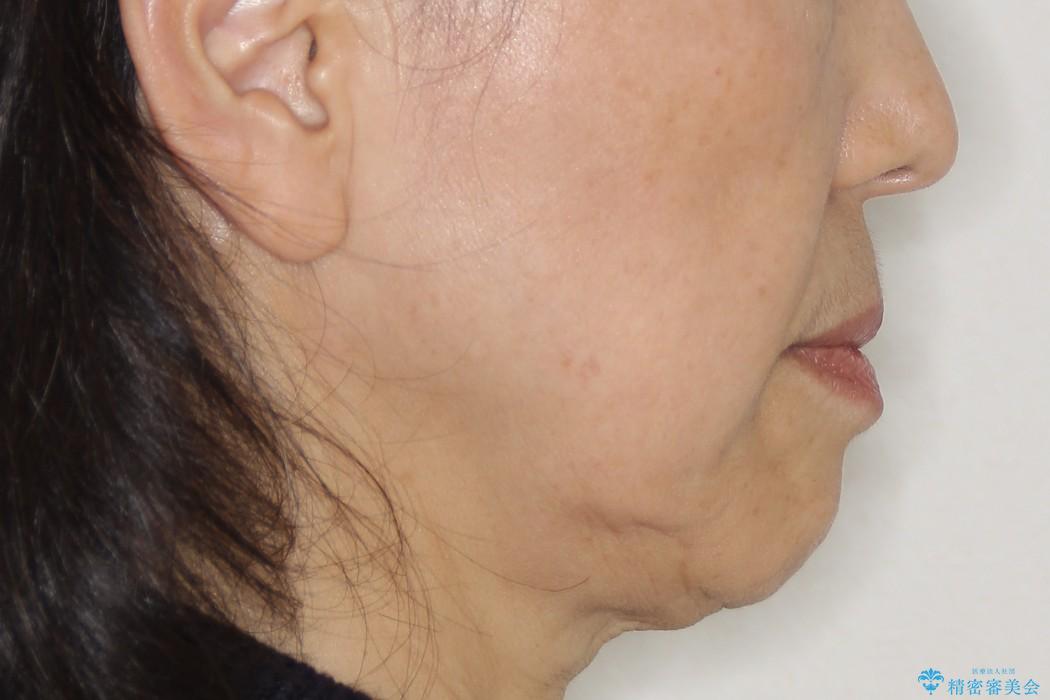 受け口(反対咬合)・裏側矯正・60代女性・2年6か月の治療後（顔貌）