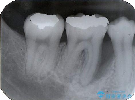 歯周組織再生治療の治療前