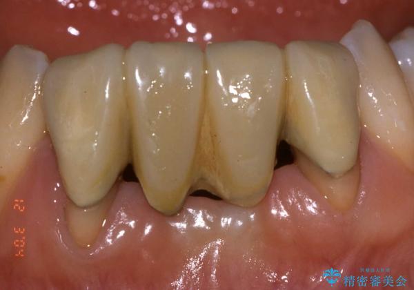 下顎前歯部の歯槽堤増大術　根面被覆　オールセラミック治療