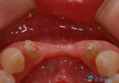下顎前歯部の歯槽堤増大術　根面被覆　オールセラミック治療の治療前