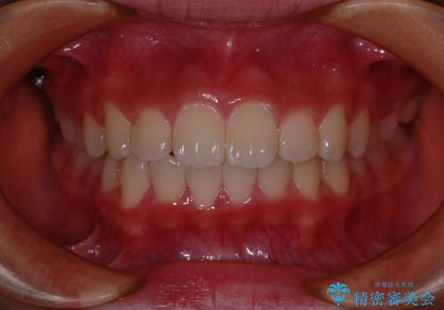 出っ歯(上顎前突)・ペンデュラム装置・メタル・小児矯正・非抜歯の治療後
