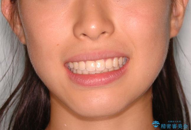 出っ歯(上顎前突)・ペンデュラム装置・メタル・小児矯正・非抜歯の治療後（顔貌）