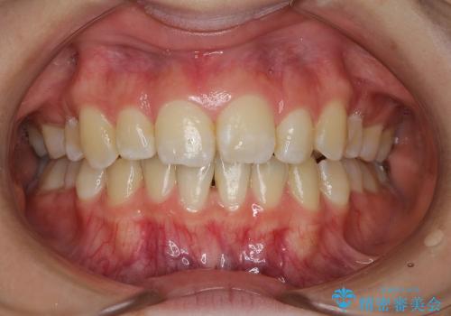 出っ歯・20代女性・裏側矯正・抜歯ケース・マイクロインプラント・2年の治療中