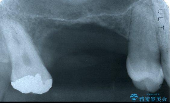 サイナスソケットリフト併用の上顎奥歯のインプラント治療の治療前（顔貌）