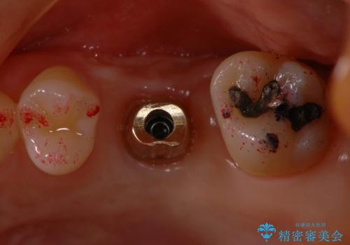 サイナスソケットリフト併用の上顎奥歯のインプラントの治療中