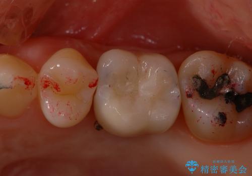 サイナスソケットリフト併用の上顎奥歯のインプラントの治療後