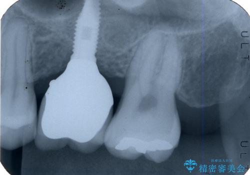 サイナスソケットリフト併用の上顎奥歯のインプラントの治療後