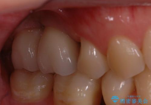 サイナスソケットリフト併用の上顎奥歯のインプラント治療の治療後
