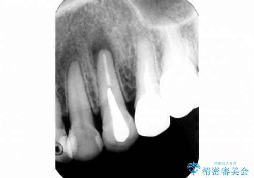 根尖病巣を持つ根管処置歯へ対する精密根管治療(再根管治療:リトリートメント)症例の症例 治療前