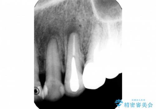 根尖病巣を持つ根管処置歯へ対する精密根管治療(再根管治療:リトリートメント)症例の治療前
