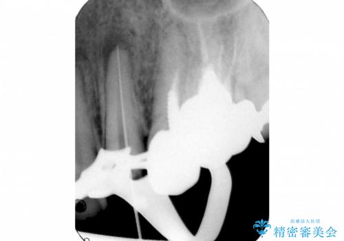 根尖病巣を持つ根管処置歯へ対する精密根管治療(再根管治療:リトリートメント)症例の治療中
