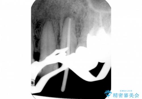 根尖病巣を持つ根管処置歯へ対する精密根管治療(再根管治療:リトリートメント)症例の治療中