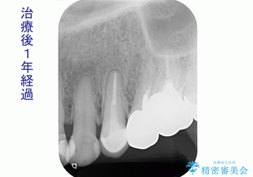 根尖病巣を持つ根管処置歯へ対する精密根管治療(再根管治療:リトリートメント)症例の治療後