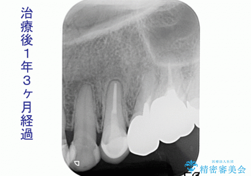 根尖病巣を持つ根管処置歯へ対する精密根管治療(再根管治療:リトリートメント)症例の症例 治療後