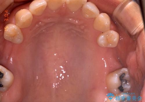 サイナスソケットリフト併用の上顎奥歯のインプラント治療の治療前