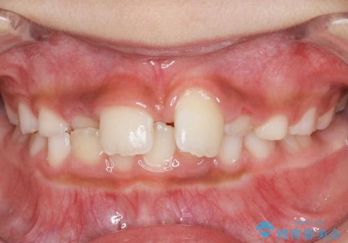 前歯のすき間　反対咬合　小児矯正の症例 治療前