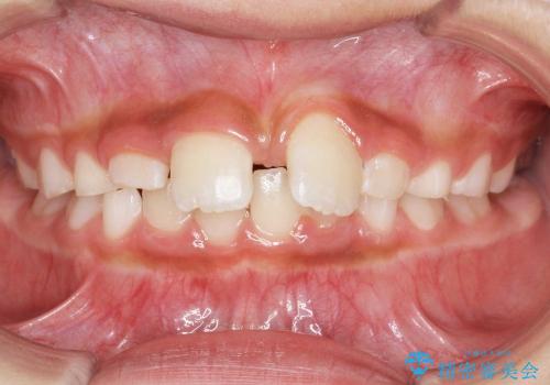 前歯のすき間　反対咬合　小児矯正の治療中