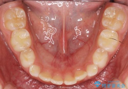 前歯のすき間　反対咬合　小児矯正の治療中