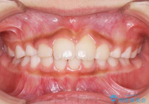 前歯のすき間　反対咬合　小児矯正の症例 治療後