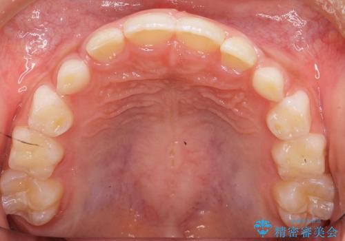 前歯のすき間　反対咬合　小児矯正の治療後