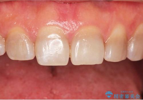 テトラサイクリン歯(薬物による変色歯)の審美的回復の治療前