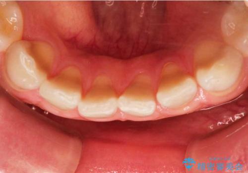 テトラサイクリン歯(薬物による変色歯)の審美的回復の治療前