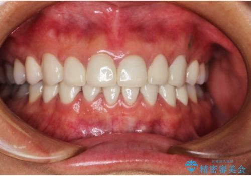 テトラサイクリン歯(薬物による変色歯)の審美的回復の症例 治療後