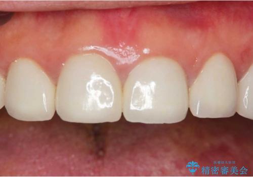 テトラサイクリン歯(薬物による変色歯)の審美的回復の治療後