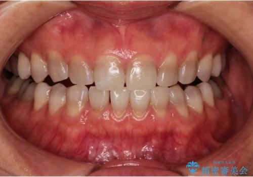 テトラサイクリン歯(薬物による変色歯)の審美的回復