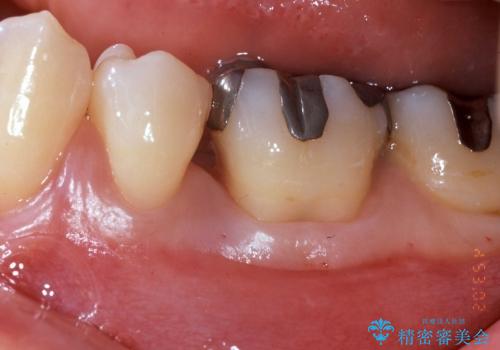 根分岐部病変と三壁性骨欠損部の歯周組織再生治療の治療前